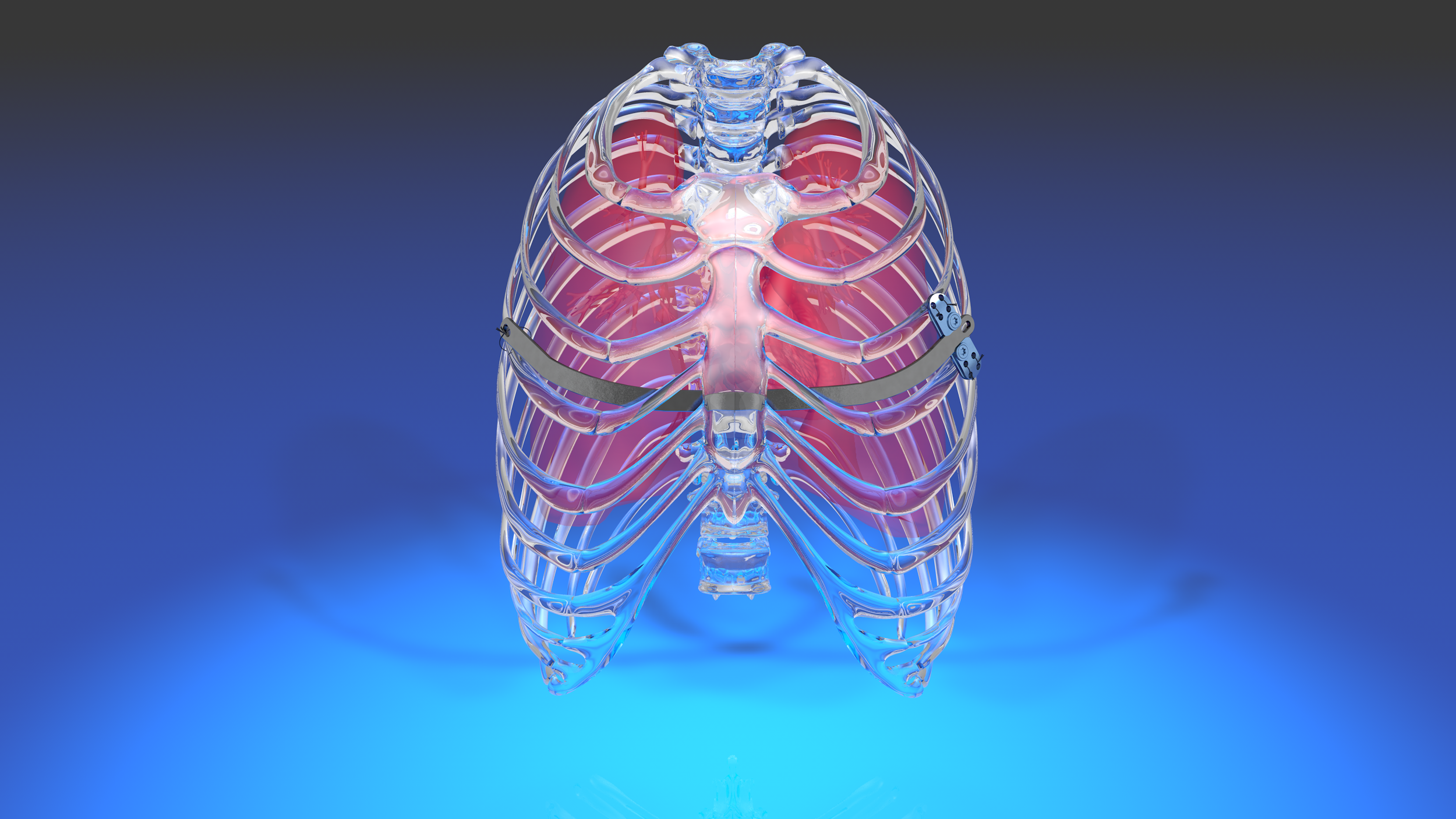 MCS Pectus System 3D animation